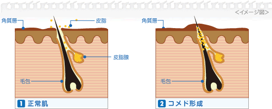 ニキビのできかた