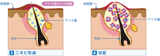 ニキビのできかた